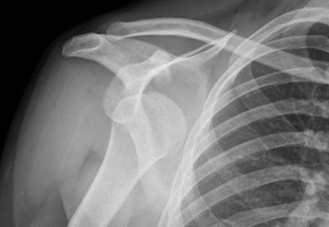 Dislocated shoulder X-ray
