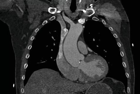 Coronal BAV aorta by CT_enlarged_CMYK