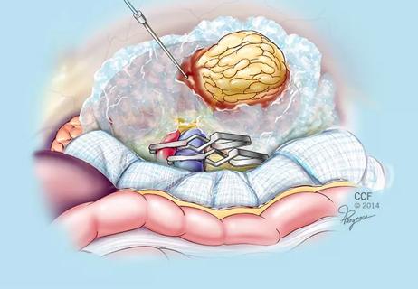 650&#215;450-NEPHRECTOMY-ice_corporeal-renal-cooling-80555-