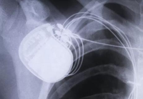 Redo Prosthetic Aortic Valve Replacement