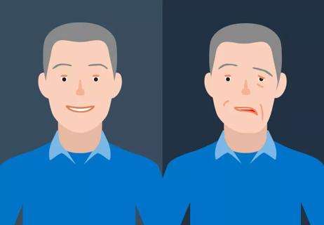 Illustration of Bell's Palsy