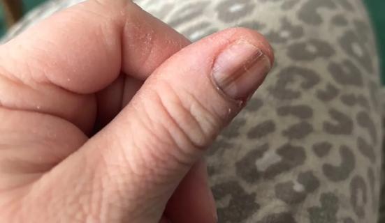 Melanoma on fingernail