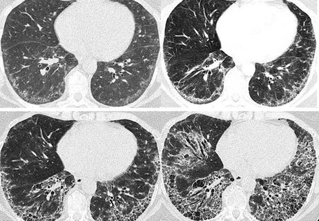 Scleroderma-related interstitial lung disease