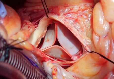 implanted bioprosthesis for aortic valve replacement