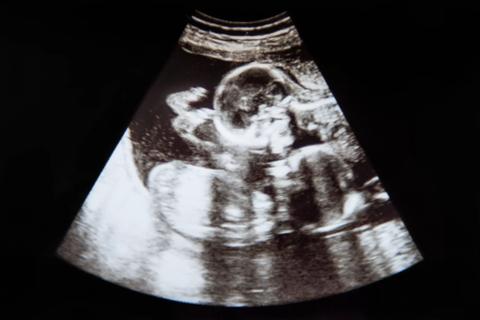 ultrasound of twin pregnancy