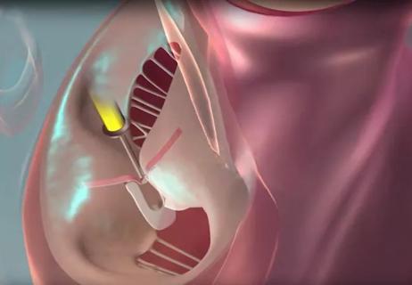 illustration of mitral valve transcatheter edge-to-edge repair