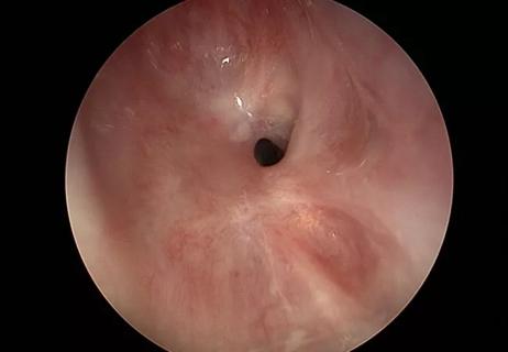 endoscopic Idiopathic Subglottic Stenosis