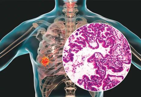 lung adenocarcimoa