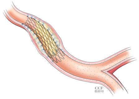 percutaneous coronary intervention