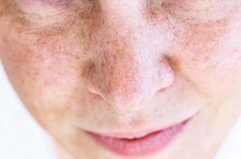 Close-up of freckled face