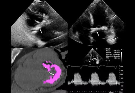 21-HVI-2396964-imaging-mitral-annular-calcification-650&#215;450