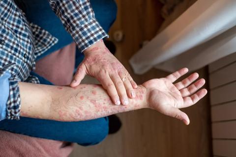Person examining psoriasis on their arm and hands