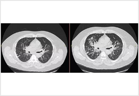 Sarcoidosis