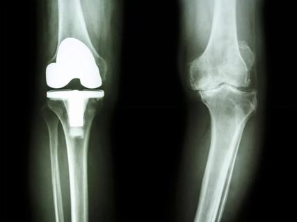film x-ray of osteoarthritis knee patient and artificial joint