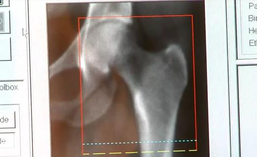 Osteoporosis