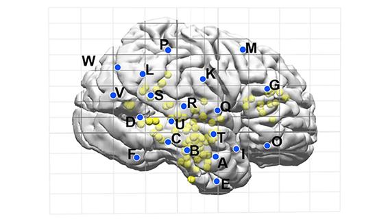 brain map showing planned electrode placement