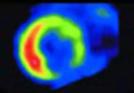 cardiac PET scan