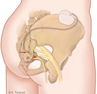 More patients regaining bowel control with first-line surgical option