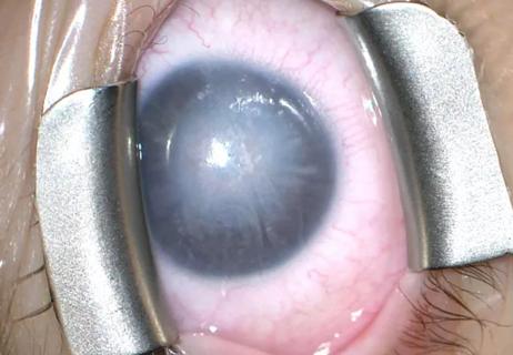 22-EYE-3499812 CQD-Cornea transplant in 1-year-old-Goshe650x450