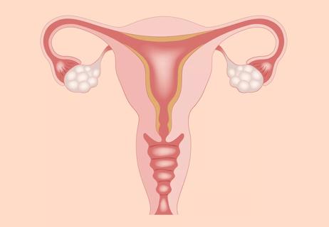 What to Expect After an Ovarian Cyst Ruptures