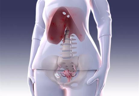 Diaphragmatic endometriosis