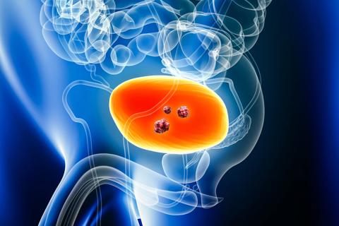 bladder cancer graphic