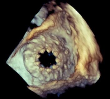 Tricuspid valve after transcatheter replacement