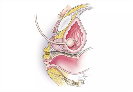Vaginal Hysterectomy for Uterine Prolapse and Vaginal Repair - Milton  Keynes University Hospital