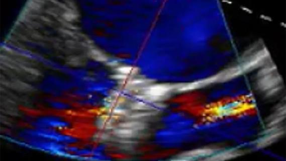 full-color echocardiogram of the heart
