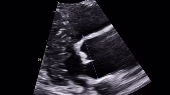Dilated aorta