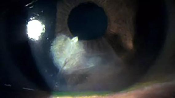 An eye showing corneal scarring after surgery