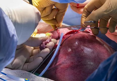 21-DDI-2269958-Cass Intrapericardial CQD1_650x450 Hero