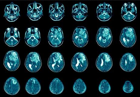 21-NEU-2498412-brain-tumor-imaging-studies-650&#215;450