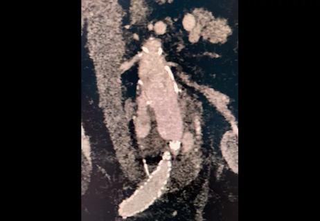 21-HVI-2246258_aortic-aneurysm-with-wide-neck_650x450