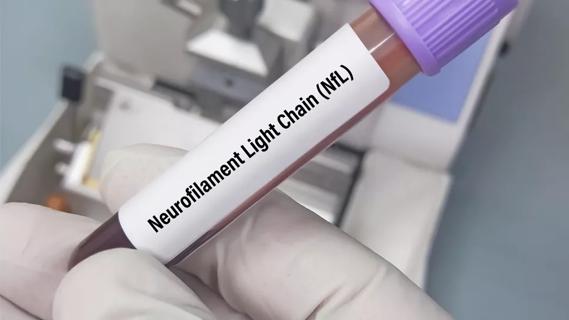 vial of blood labeled "neurofilament light chain"