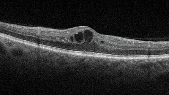 Diabetic macular edema