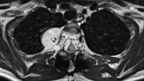 vertebral hemangioma on MRI
