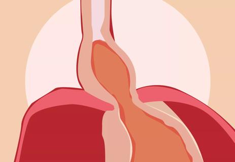 hiatal hernia illustration