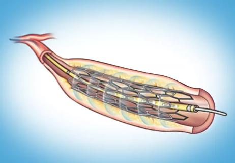 illustration of intracoronary brachytherapy