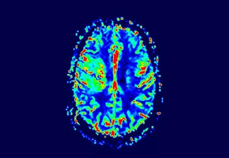 19-NEU-5569-glioblastoma-perfusion-image-650&#215;450