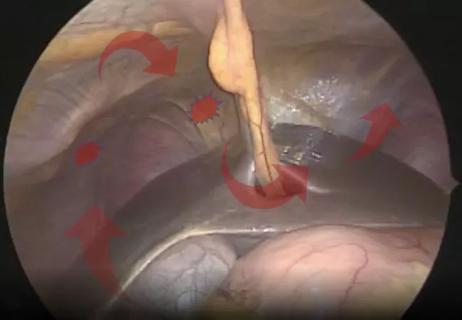 Diaphragmatic endometriosis