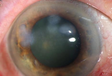 Eye with Salzmann's nodular degeneration