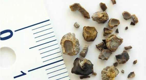 650&#215;450-Kideny-Stones