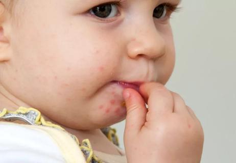 Child with hand foot and mouth disease