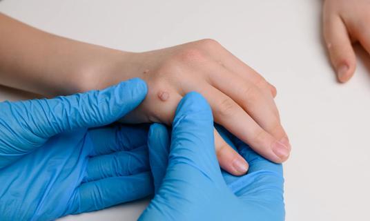 Gloved healthcare provider hands holding a child's hand with a wart on it