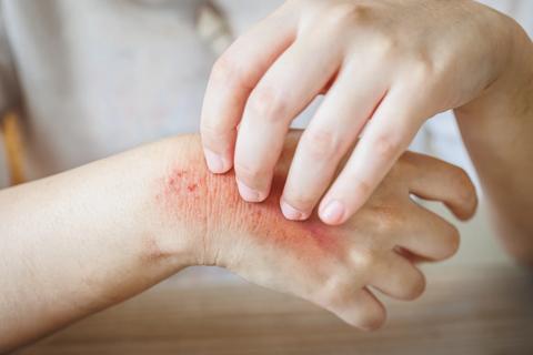 Patient with rash on hand
