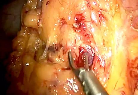 650&#215;450-preserving-pancreaticoduodenectomy