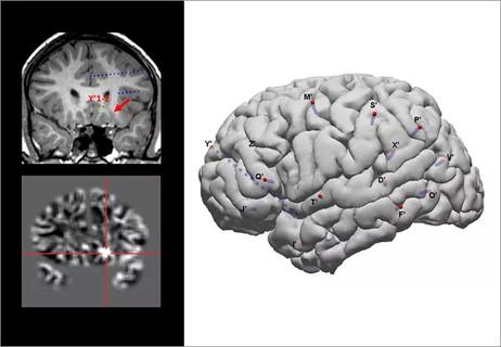 650&#215;450-Wang-Neurology