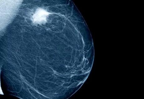 650&#215;450-Breast-Cancer