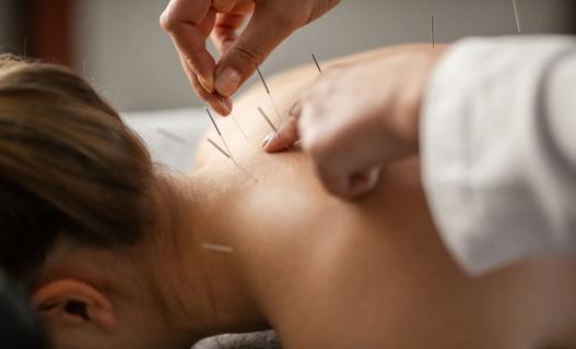 Person receiving acupuncture along shoulders and back